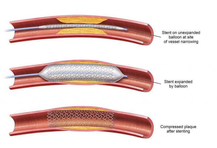 A patient with coronary atherosclerosis underwent a ptca