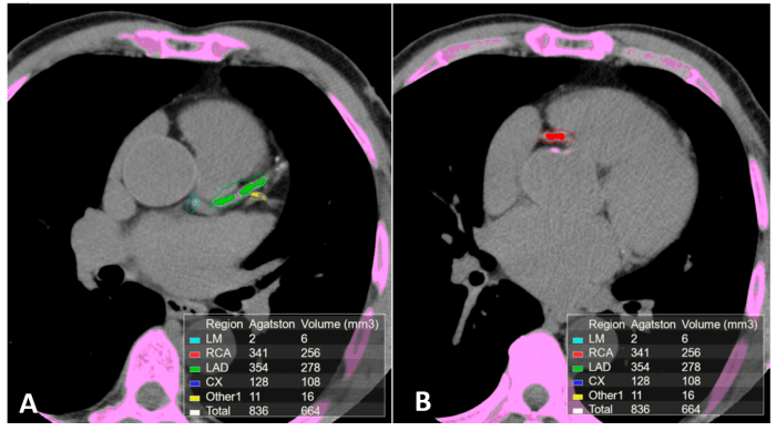 Coronary atherosclerosis calcium diagnostics scoring angiography cac