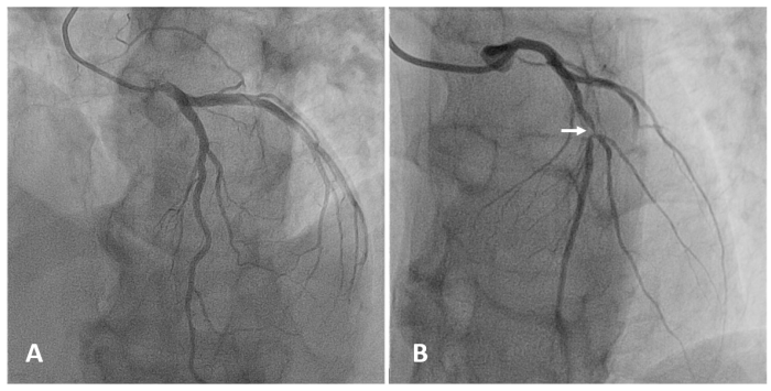 A patient with coronary atherosclerosis underwent a ptca