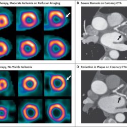 Ptca cabg post stent stenosis