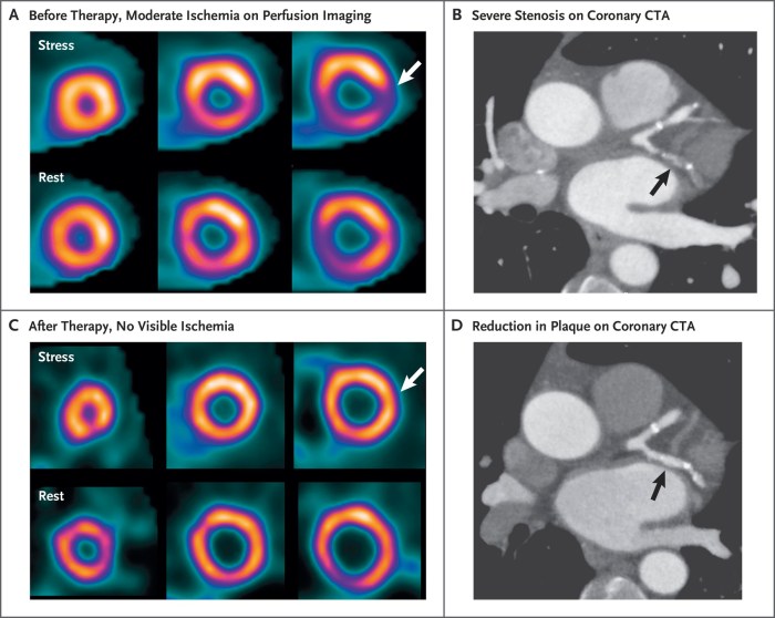 Ptca cabg post stent stenosis